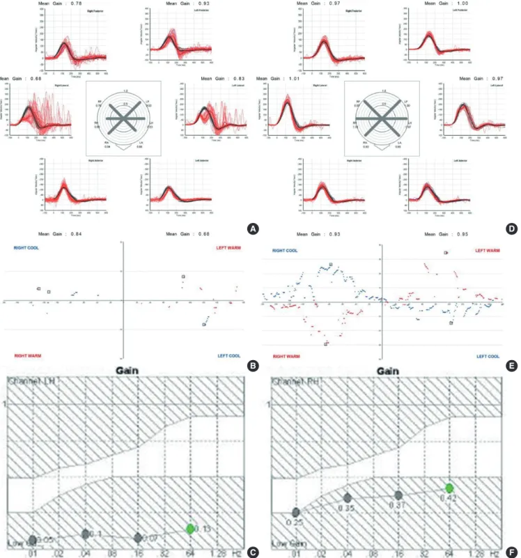 Fig. 2. Video head impulse test (vHIT) show decreased vestibule-ocular gains for horizontal semicircular canals on both sides with covert and overt corrective sac- sac-cades (A)