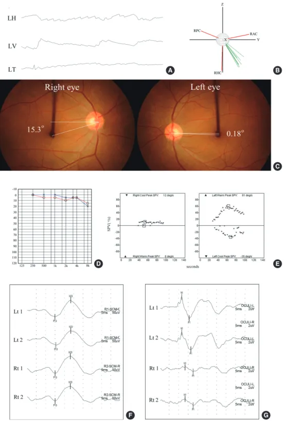 Fig. 2. Clinical features of superior vestibular neuritis (VN). (A) The patient with right VN involving the superior division shows left beat, upbeat, and counterclockwise  (from the patient’s perspective) torsional nystagmus