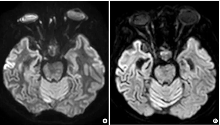 Fig. 5. Comparison between (A) single-shot and (B) multi-shot echo-planar imaging-based diffusion-weighted images