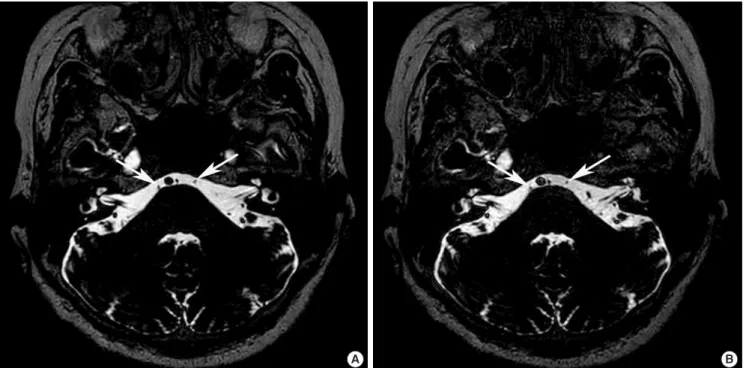 Fig. 12. Comparison of (A) standard and (B) fast compressed sensing imaging of high-resolution heavily T2-weighted image