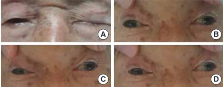 Fig. 1. Internuclear ophthalmoplegia in right eye and oculomotor nerve palsy in  left eye