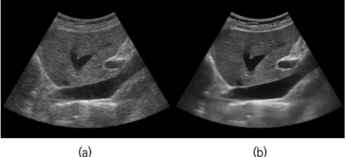 Fig.  1.  Example  of  Improving  Visibility  using  Image  Processing  in  Liver  Ultrasound(US)  Image,  (a)  Original  Liver  US  Image, 