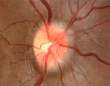 Fig. 1. Grade I papilledema is characterized by a C-shaped halo with a temporal  gap. 