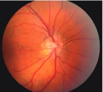 Fig. 5.  Optic disc drusen. Numerous superficial optic disc drusen causing a 