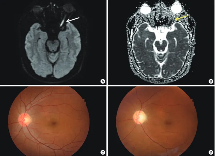 Fig. 4. Diffusion weighted MRI (A), apparent diffusion coefficient (ADC, B) and fundus views (C, D) of the posterior ischemic optic neuropathy (PION)