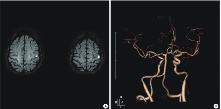 Fig. 1. Brain magnetic resonance images and computed tomographic angiography. Diffusion-weighted images (A) reveal infarction of the left precentral gyrus