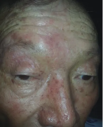 Fig. 2. Nine cardinal gazes. Diagnostic action fields of gaze showed limitations  of medial, upward, and downward gaze in the right eye