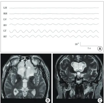 Fig. 2. (A) Three dimensional video-oculographic recording shows pendular os- os-cillation of the eyes with conjugate torsional components and the vertical  com-ponents in the opposite direction