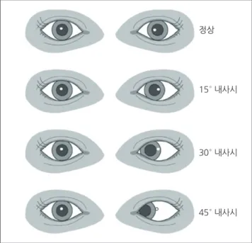 Fig. 1. Hirschberg test. Angle of deviation can be measured semiquantitatively  using corneal light reflex test.