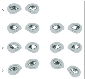 Fig. 5. The diagnosis of vertical ocular misalignment. The steps in the diagnosis  of a left superior oblique muscle palsy are presented