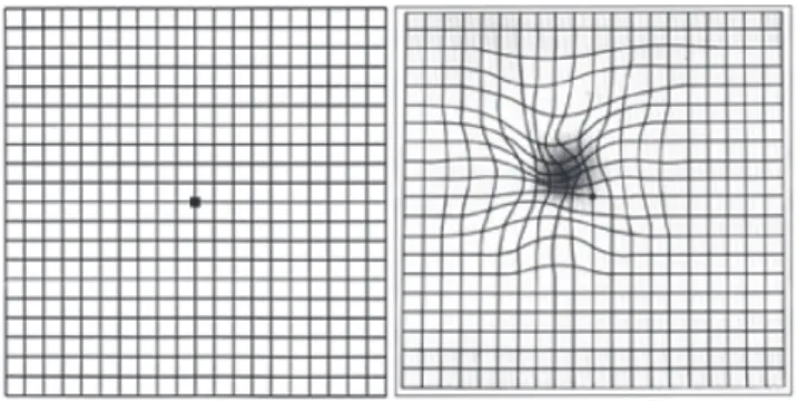 Fig. 1. Example of an Amsler grid chart to test central vision (the left chart). Pa- 1. Example of an Amsler grid chart to test central vision (the left chart). Pa-tients with macular disease often see a bent or warped appearance of the grid  lines (the ri