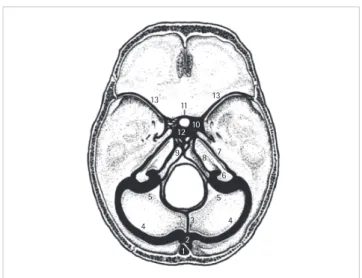 Fig. 2. Dural venous sinus in skull base. 1= superior sagittal sinus, 2= conflu- conflu-ence of sinuses; 3= occipital sinus; 4= transverse sinus; 5= sigmoid sinus; 6=  