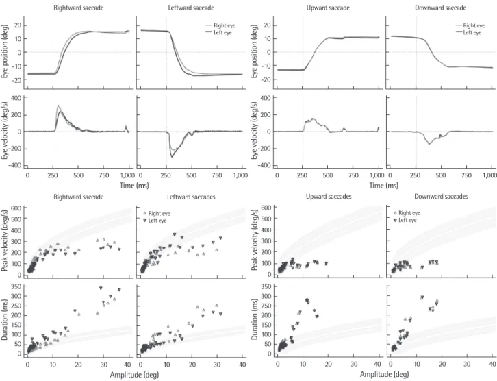 Fig. 4. Saccadic abnormalities in a 70-year-old man with bulbar onset amyotrophic lateral sclerosis. Eye movement recordings using the magnetic search coil tech- 4. Saccadic abnormalities in a 70-year-old man with bulbar onset amyotrophic lateral sclerosis