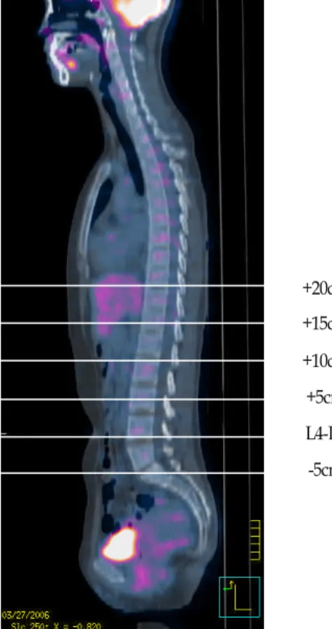 Figure  1.  Sagittal  image  showing  measurement  location량을  더  잘  반영한다는  보고가  있으며,  요추  2~3번  위치나10)요추  4~5번  상방  10cm  혹은  15cm  위치가11)  요추  4~5번보다 대사위험요인과  더  관련성이  높다고  보고도  있다