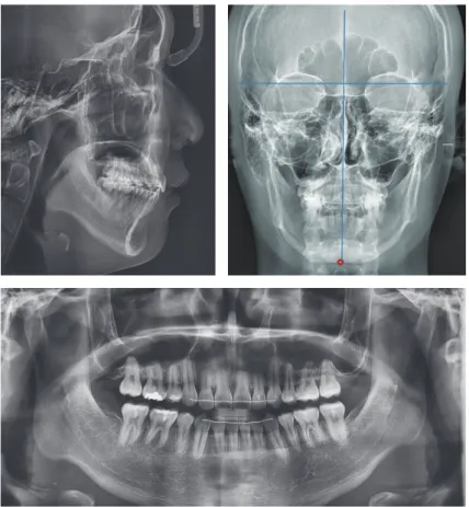 Figure 12.	Radiographs,	14	months	after	treatment.
