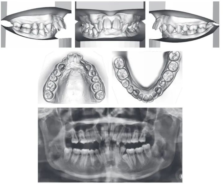 Figure 2.	Dental	model	and	panoramic	radiograph	before	treatment.