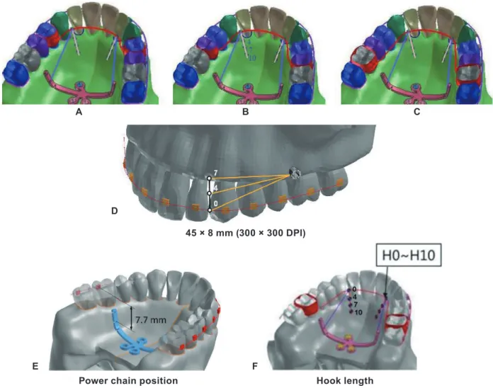 Figure 2.	Installation	of	simulated	distalization	modalities	on	finite	element	model	45	×	8	mm	(300	×	300	DPI).	A,	Modality	1,	first	 premolar	as	the	location	of	force	application	using	MCPP.	B,	Modality	2,	second	premolar	as	the	location	of	force	applicat