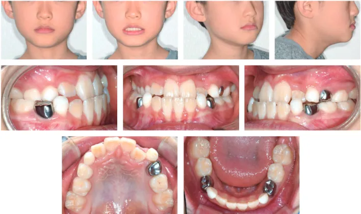 Figure 2. Pretreatment	dental	casts.