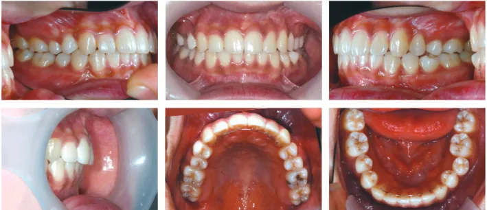 Figure 8.	Panorama,	lateral	cephalograms	and	superimposition	of	cephalometric	tracings	before	(black)	and	after	(red)	treatment.