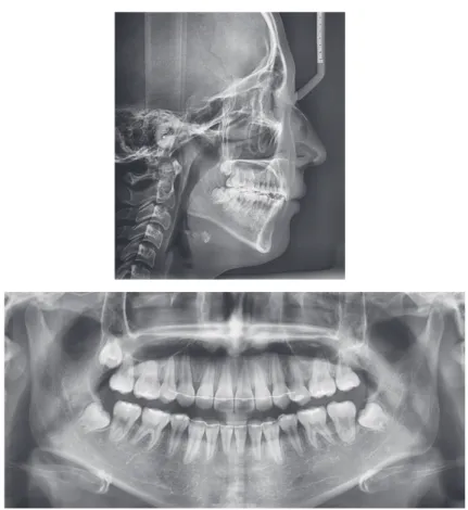 Figure 6.	Posttreatment	lateral	cephalometric	and	panoramic	radiographs.
