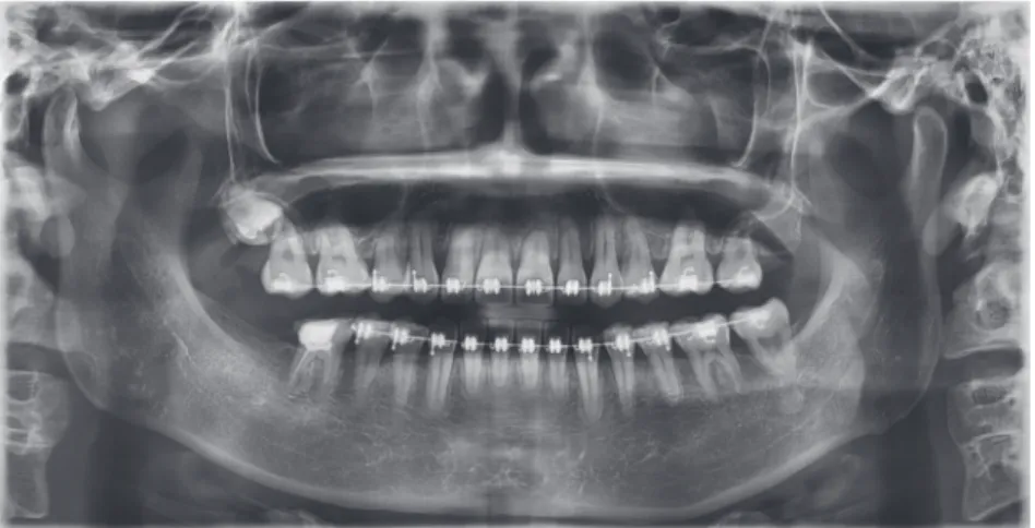 Figure 4.	Treatment	progress.	Panoramic	radiograph	after	27	months.		