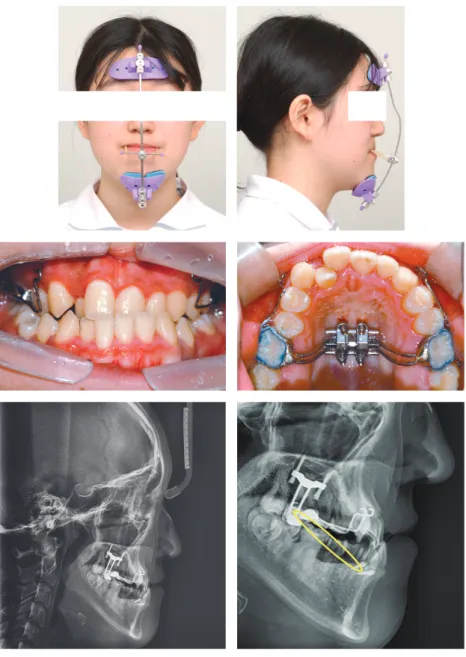 Figure 3. Application	of	face	mask	and	maxillary	skeletal	expander	(MSE).