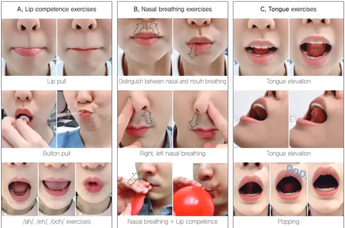 Figure 4.	Myofunctional	therapy	(MFT)	for	training	lip	competence	(A),	nasal	breathing	(B),	and	tongue	elevation	(C).Lip	pullButton	pull/ah/,	/eh/,	/ooh/	exercisesPoppingDistinguish	between	nasal	and	mouth	breathingRight,	left	nasal	breathingNasal	breathin