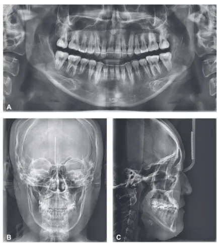 Table 3.	Comparison	of	cephalometric	measurements