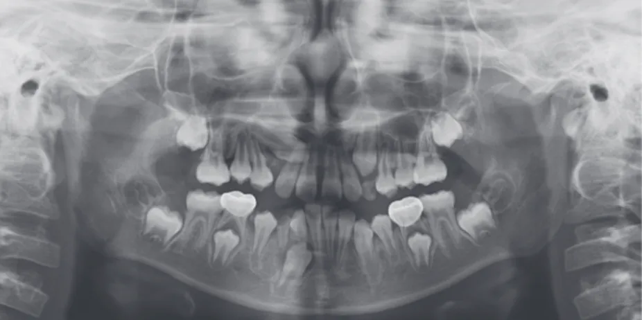 Figure 3.	Pretreatment	lateral	cephalometric	radiograph.