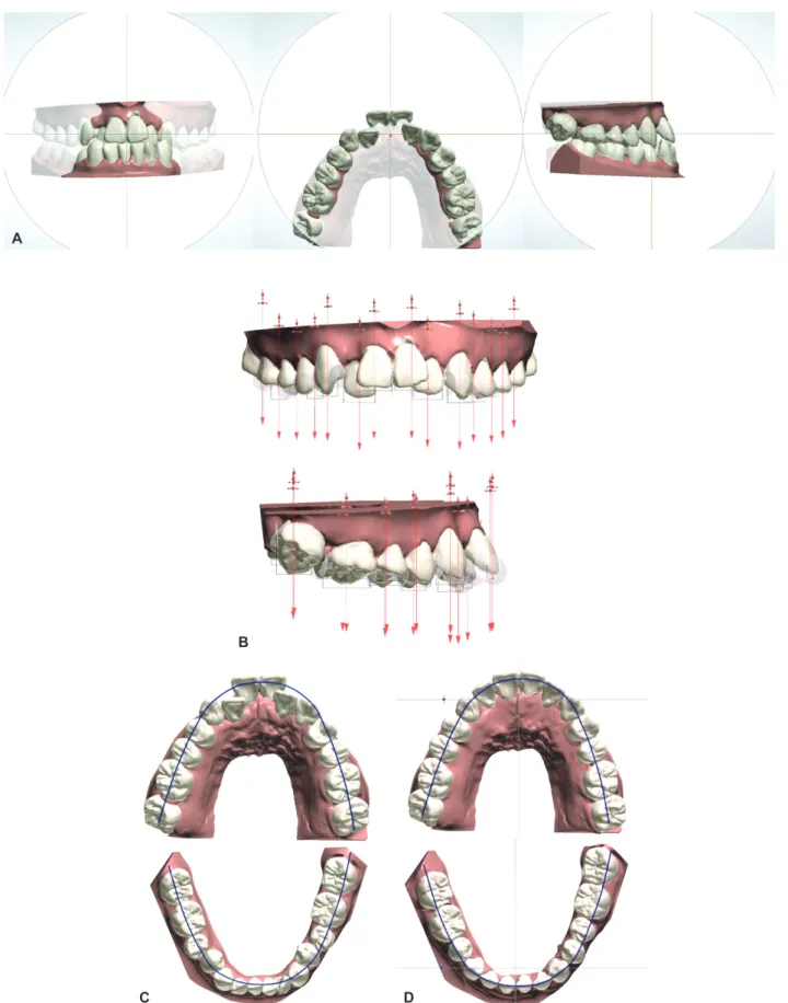 Figure 10.	Virtual	set-up	process.	A,	3D	coordinated	system.	B,	Tooth	axis	setting.	C,	Line	of	occlusion	of	treatment	goal