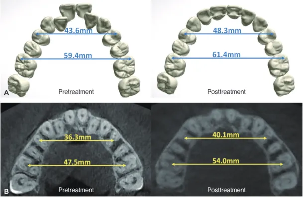 Figure 6.	Intermolar	and	interpremolar	width	changes.	A, Scanned	model.	B,	CBCT	images.