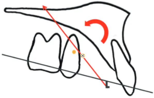 Figure 6. Treatment	progress.	A, After	9	months.	B,	After	14	months.	The	position	and	direction	of	hook	on	the	working	wire	were	 changed.	The	distance	between	screw	and	wire	decreased	after	intrusion	of	the	whole	maxillary	dentition.	