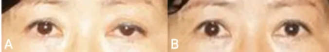 Figure 2. Starch iodine test of present case. Starch iodine prepara- prepara-tion (A) becomes blue-purple color on exposure to sweat after 30  minutes of exercise on her right face only (B)