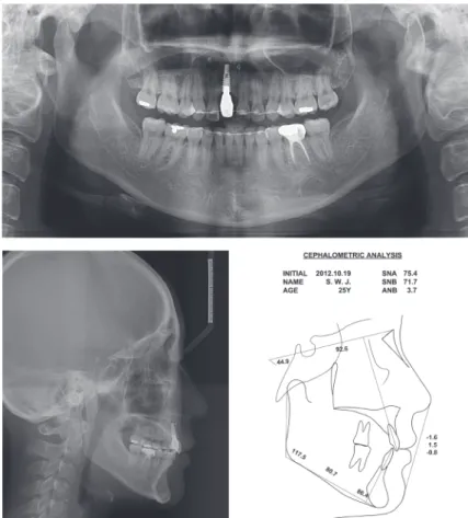 Figure 7. Posttreatment	radiographs	and	cephalometric	tracing.