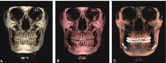 Figure 8. A, Presurgical	3D	CBCT.	B, Postsurgical	3D	CBCT	after	1	week.	C, Superimposition	view.