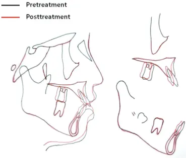 Table 2. Changes	in	intercanine	width	and	intermolar	width	during	treatment