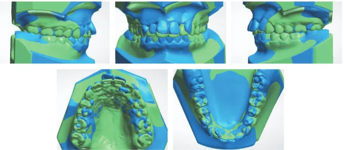 Table 3. Measurements	of	tooth	width	(sum)	and	amount	of	interproximal	reduction	(IPR)