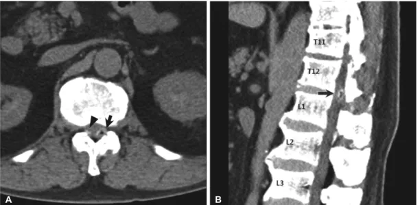 Figure 2. CT images of thoracolumbar spine in the patient. Axial (A) and saggital CT image (B) show 0.8 cm-sized  synovial cyst (arrow) containing gaseous component and calcification around it