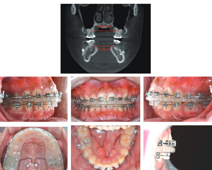 Figure 8.	After	mandibular	advancement	surgery.	CBCT	revealed	2	mm	basal	arch	width	difference	between	maxillary	first	molar	 and	mandibular	second	molar.