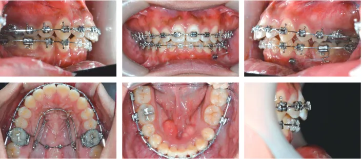 Figure 10.	Distalization	of	maxillary	molars	during	post-surgical	orthodontics.	