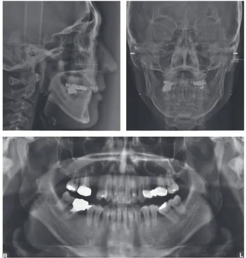 Figure 3.	Pretreatment	lateral	and	posteroanterior	cephalograms,	and	panoramic	radiograph.