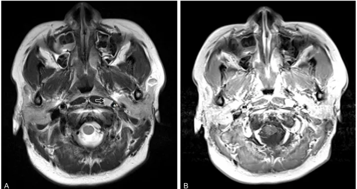 Figure 2. Follow-up magnetic resonance (MR) images, axial T2-weighted (A) and T1-weighted contrastenhanced (B), after 4 months show  slightly reduced tumor size of 1.1 cm (open white arrow) and less compressing effect on left internal carotid artery (*) in