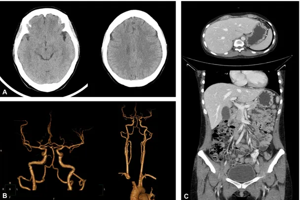 Figure 1. Imaging studies. (A) Brain CT revealed no significant brain parenchymal abnormalities