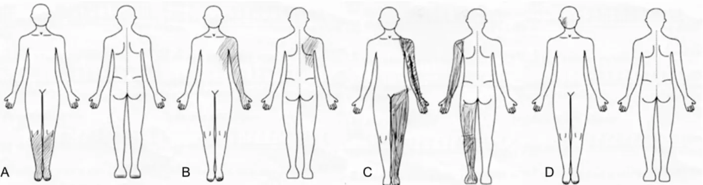 Figure 2. Location of the pain distribution that patients are drawn according to the lesion site