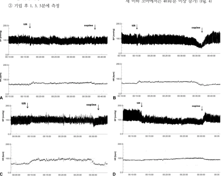 Figure 4. Responses to Head-up tilt testing. (A) Normal response. (B) Neurally mediated syncope