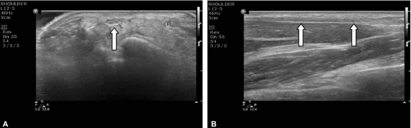 Figure 2. Axial (A) and longitudinal (B) sonograms of the carpal tunnel at the level of the wrist