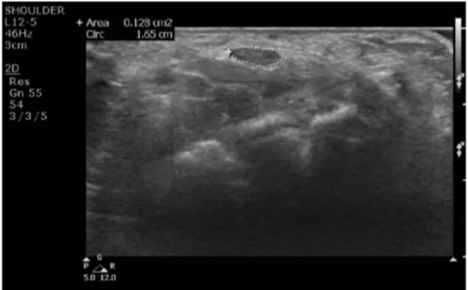 Figure 4. Sonographic findings of the carpal tunnel syndrome at  the scaphoid-pisiform level