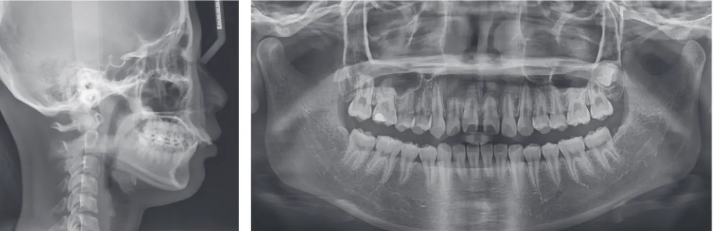Figure 3. Pretreatment	lateral	cephalogram	and	panoramic	radiograph.