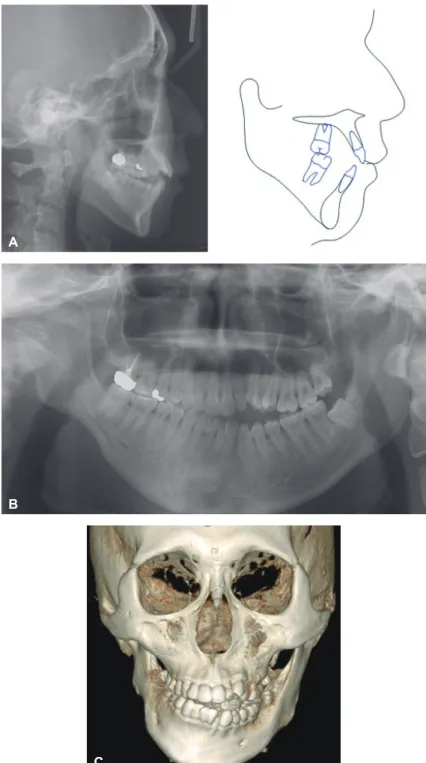 Figure 3. Pretreatment	radiographs.	A,	Lateral	cephalogram	and	tracing.	B,	Panoramic	radiograph.	C,	Frontal	view	of	cone-beam	 computed	tomography	(CBCT)	image.