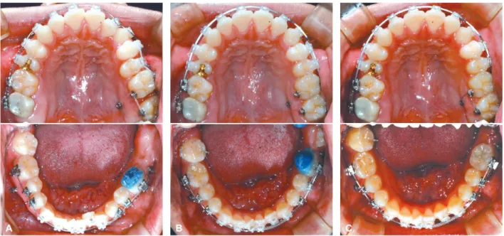 Figure 4. Treatment	progress	photographs.	A, After	4	months.	B,	After	9	months.	C,	After	11	months.	